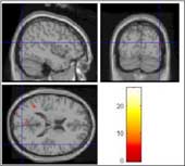 La resonancia magnética permite detectar cuando el cerebro miente