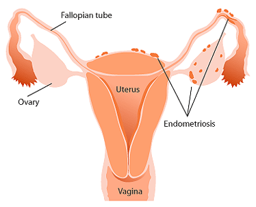 La endometriosis ya puede ser causa de incapacidad absoluta